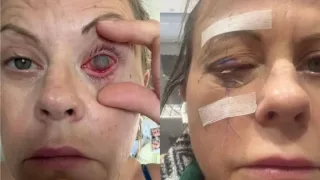 Kontakt linzadan noto‘g‘ri foydalanish ko‘rish qobiliyatini xavf ostiga qo‘ydi