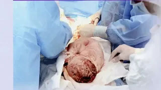 Homilador ayollarga kesarcha kesishni o‘z ixtiyori bilan tanlash huquqi berildi