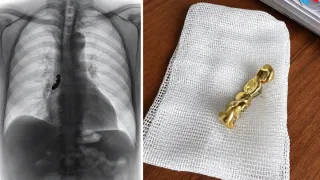 Rossiyalik erkak bronxidan tilla tishli protez olib tashlandi