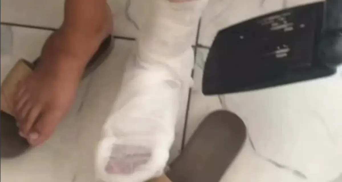 Qozog‘istonda shifokorlar bolaning sog‘lom oyog‘iga gips qo‘yishdi